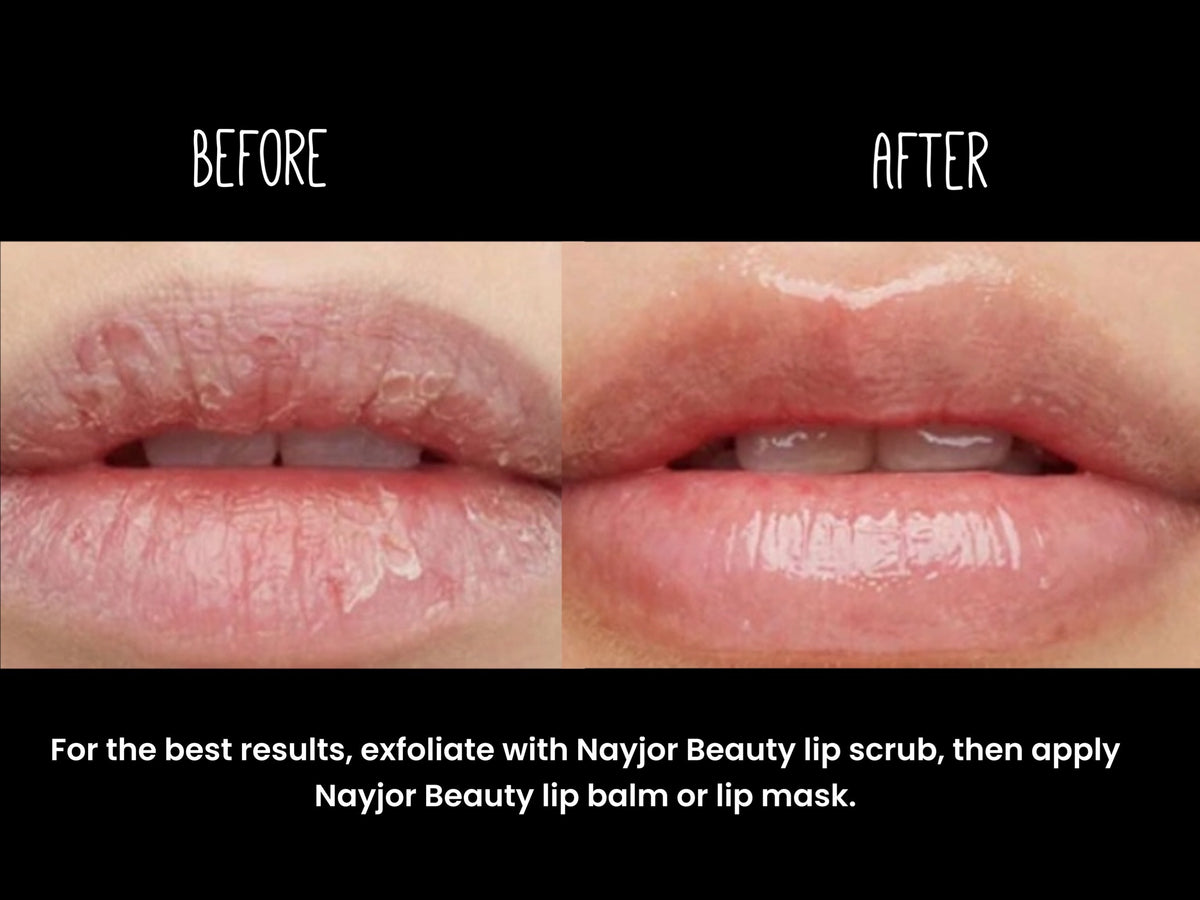 Do you suffer from dry chapped lips?