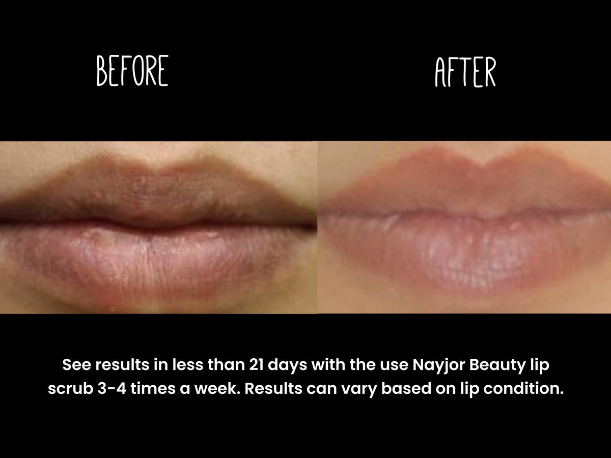 Experiencing Dark or Chapped Lips?